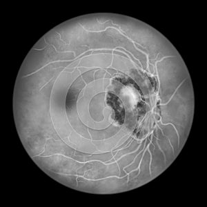 Retinal scar caused by a Toxoplasma gondii infection, or toxoplasmosis, scientific illustration