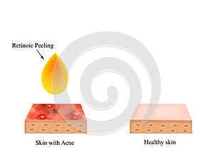 Retinoic peeling for acne. Inflamed skin acne. Acne purulent. The anatomical structure of the skin. Infographics. Vector