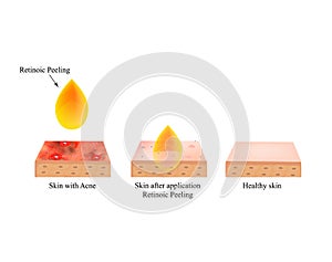 Retinoic peeling for acne. Inflamed skin acne. Acne purulent. The anatomical structure of the skin. Infographics. Vector