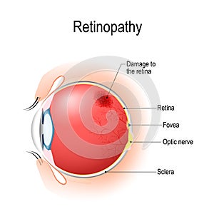 Retinopathy. Vertical section of the eye and eyelids with damage photo