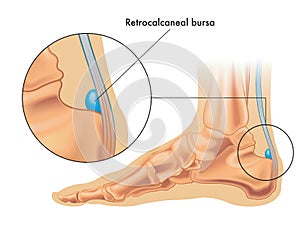 Retrocalcaneal bursa medical illustration photo