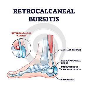 Retrocalcaneal bursitis as ankle or achilles tendon bursa outline diagram