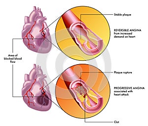 Reversible and progressive angina