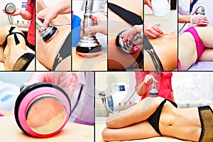 Rf skin tightening, belly. Hardware cosmetology. Body care. Non surgical body sculpting. Ultrasound cavitation body contouring tre