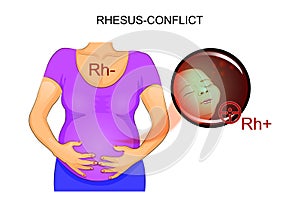 RH-conflict pregnant photo