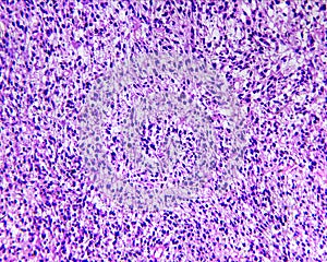 Rhabdomyosarcoma of a human