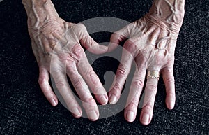 Rheumatica, Womans hand with heumatoid arthritis hands and fingers since forty year since first diagnosis.