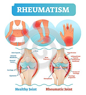 Rheumatism medical health care vector illustration poster diagram with damaged knee erosion and painful body joints.