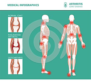 Rheumatism or rheumatic disorder medical posters. Arthritis joint pain. Rheumatology vector infographics photo