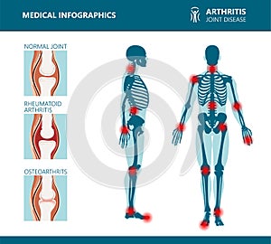 Rheumatism or rheumatic disorder medical posters. Arthritis joint pain. Rheumatology vector infographics photo