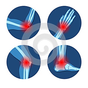 Rheumatism or rheumatic disorder medical set. Arthritis joint pain. Rheumatology vector infographics photo