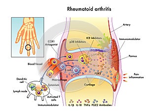 Rheumatoid Arthritis photo