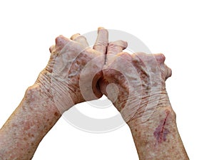 Rheumatoid Arthritis photo