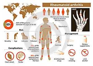 Rheumatoid arthritis