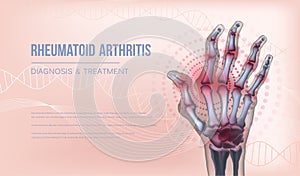 Rheumatoid arthritis banner hand joints deformation. photo