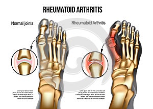 Rheumatoid arthritis Bones the of foot