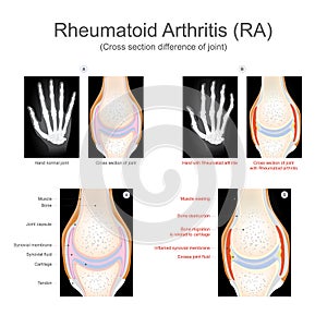 Revmatoidní artritida 