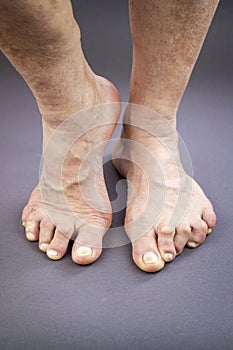 Rheumatoid Arthritis feet