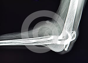 Rheumatoid arthritis finger xray pathology