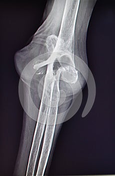 Rheumatoid arthritis finger xray pathology