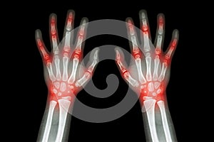 Rheumatoid arthritis , Gout arthritis ( Film x-ray both hands of child with multiple joint arthritis ) ( Medical , Science and He