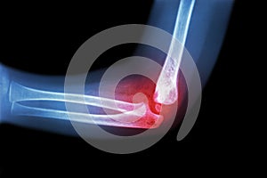 Rheumatoid arthritis , Gouty arthritis ( film x-ray child's elbow with arthritis at elbow ) ( Side view , Lateral ) photo