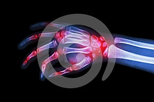 Rheumatoid arthritis , Gouty arthritis ( Film x-ray hand of child with arthritis at multiple joint ) photo