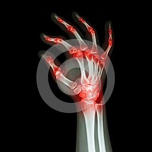 Rheumatoid Arthritis , Gouty Arthritis