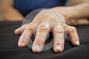 Rheumatoid arthritis hand