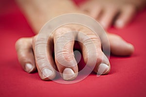 Rheumatoid arthritis hand