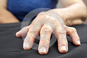 Rheumatoid Arthritis hand