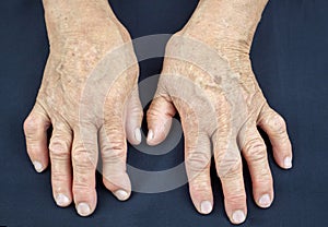 Rheumatoid Arthritis hands