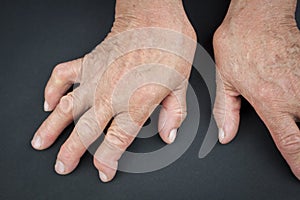 Rheumatoid arthritis hands