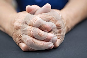 Rheumatoid Arthritis hands photo