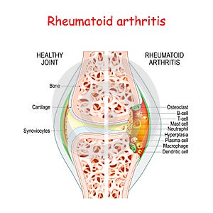 Rheumatoid arthritis. Healthy and damage joint photo