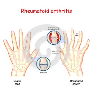 Rheumatoid Arthritis. Healthy hand, and hand with rheumatoid arthritis