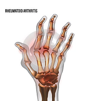 Rheumatoid arthritis image sore inflammation joints of bones the of hand. photo