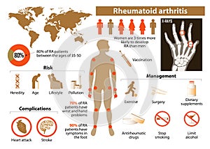 Rheumatoid arthritis photo