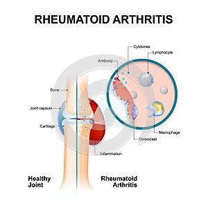 rheumatoid arthritis. normal joint and one with rheumatoid arthritis.