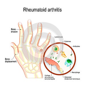 Rheumatoid Arthritis RA is an auto immune disease and inflammatory type of arthritis