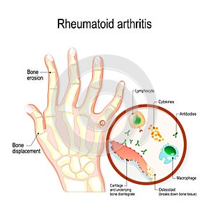 Rheumatoid Arthritis RA is an auto immune disease and inflammatory type of arthritis photo