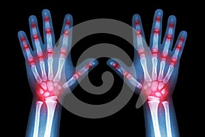 Rheumatoid arthritis ( X-ray both child hands and multiple joint arthritis )