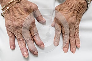 Rheumatoid Arthritis, Senior Hands photo