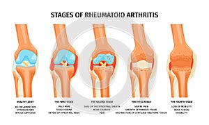 Rheumatoid Arthritis Stages Infographics