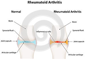 Rheumatoid Arthritis Synovial Joint