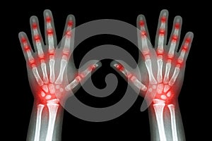 Rheumatoid arthritis ( X-ray both child hands and multiple joint arthritis )