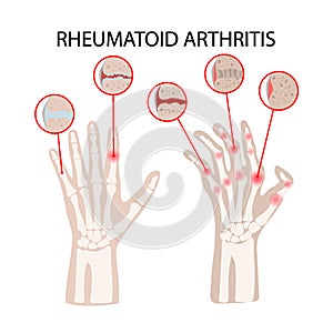 RHEUMATOID ARTRITIS DISEASE Medicine Education Vector Scheme photo