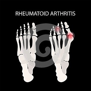RHEUMATOID ARTRITIS LEG Medicine Education Vector Scheme photo