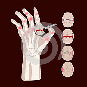 RHEUMATOID DISEASE Artritis Medicine Education Vector Scheme