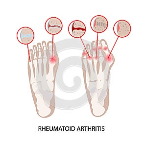 RHEUMATOID DISEASE LEG Artritis Medicine Education Scheme photo